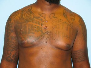 Patient 4 Before Gynecomastia Front View