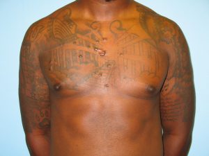 Patient 4 After Gynecomastia Front View