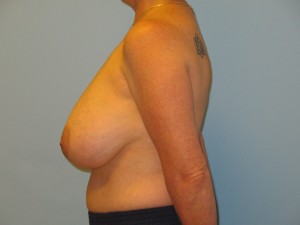 Patient with Celtic Tattoo After Breast Surgery Left View Copy 1