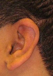 Patient 3 After Reconstruction Left Ear