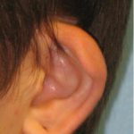 Patient 4 Before Reconstruction Left Ear