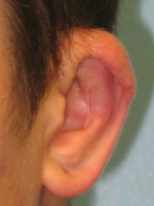 Patient 4 After Reconstruction Left Ear