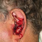 Patient 5 Before Reconstruction Left Ear