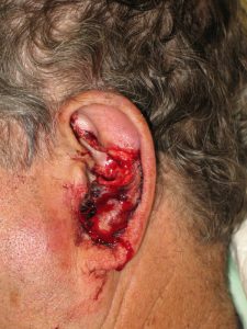 Patient 5 Before Reconstruction Left Ear