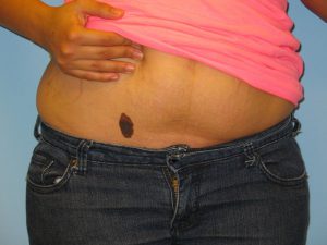 Patient 6 Before Reconstruction Birthmark on Abdomen