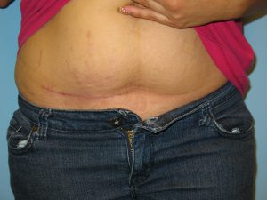 Patient 6 After Reconstruction Birthmark on Abdomen