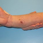 Patient 7 After Reconstruction Mark on Arm
