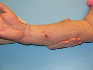 Patient 7 After Reconstruction Mark on Arm