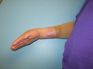 Patient 7 After Reconstruction Mark on Arm