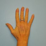Patient 8 Mark on Hand Before Reconstruction