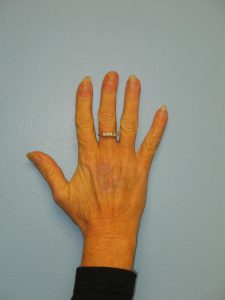 Patient 8 Mark on Hand Before Reconstruction