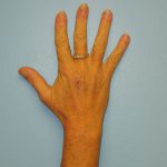 Patient 8 Mark on Hand After Reconstruction