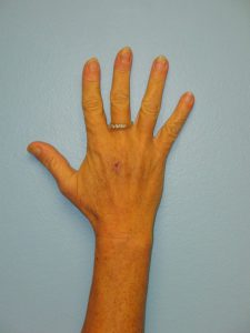 Patient 8 Mark on Hand After Reconstruction