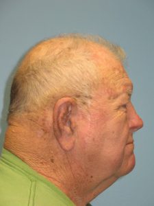 Patient 9 Marks on Face Before Reconstruction