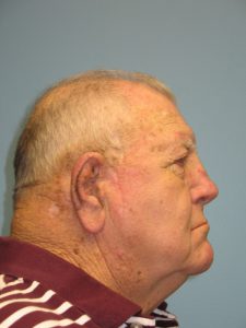 Patient 9 Marks on Face After Reconstruction