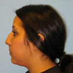 Patient 4 Before Rhinoplasty Left Side View