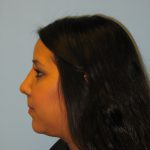Patient 4 After Rhinoplasty Left Side View