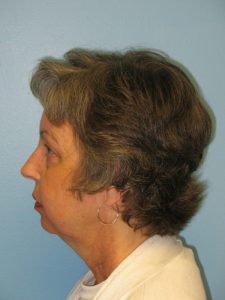 Patient 5 Before Rhinoplasty Left Side View