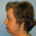 Patient 5 After Rhinoplasty Left Side View