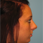 Patient 6 Before Rhinoplasty Right Side View