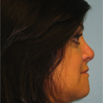 Patient 7 After Rhinoplasty Right Side View