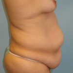 Patient 4 Before Abdominoplasty Right Side View