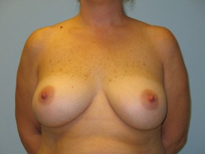 Patient 14 After Breast Augmentation