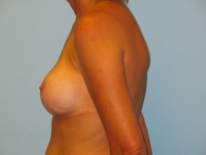 breast augmentation before 13a
