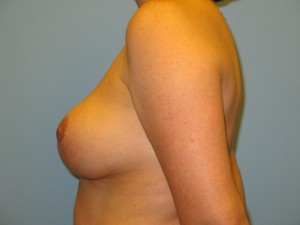 Patient I After Breast Reduction Left View