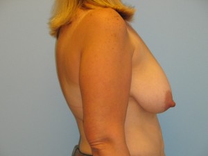 Patient 17 Before Breast Reduction Left View