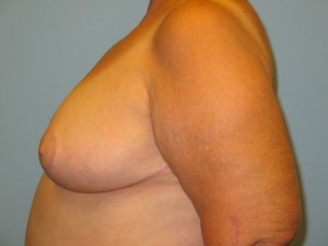 Patient 18 After Breast Reduction Left View