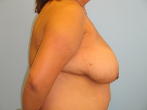 Patient E Before Breast Reduction Right View