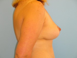 Patient 17 After Breast Reduction Left View