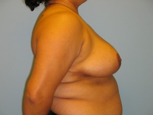 Patient 10 After Breast Reduction Right View