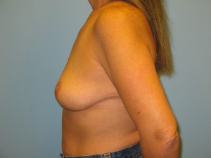 Patient G Before Breast Reduction Left View