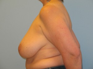 Patient D Before Breast Reduction Left View