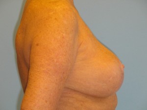 Patient F After Breast Reduction Right View