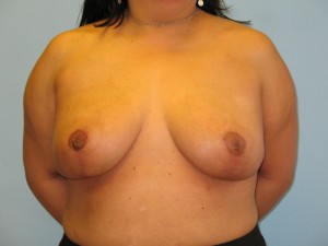 Patient E After Breast Reduction Front View