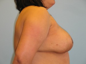 Patient E After Breast Reduction Right View
