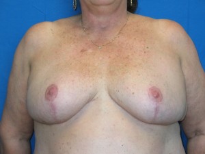 Patient 19 After Breast Reduction Front View