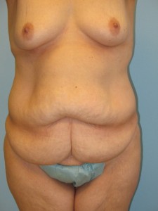 Patient 4 Before Abdominoplasty Front View