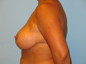 Patient 20 After Breast Reduction Left View