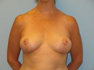 Patient C After Breast Reduction Front View