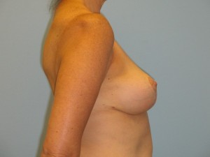 Patient C After Breast Reduction Right View