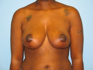 Patient H After Breast Reduction Front View
