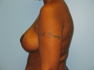 Patient H After Breast Reduction Front View