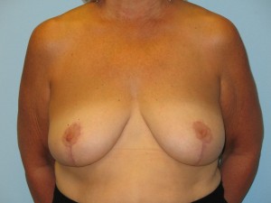 Patient D After Breast Reduction Front View