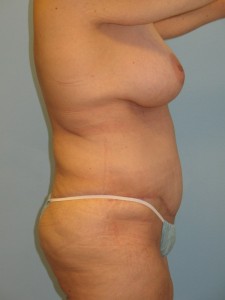 Patient 4 After Abdominoplasty Right Side View