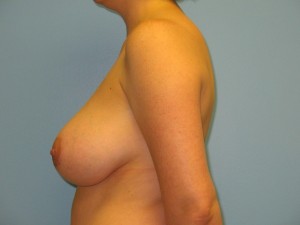 Patient I Before Breast Reduction Left View