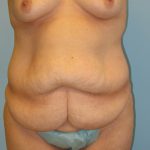 Patient 4 Before Abdominoplasty Front View